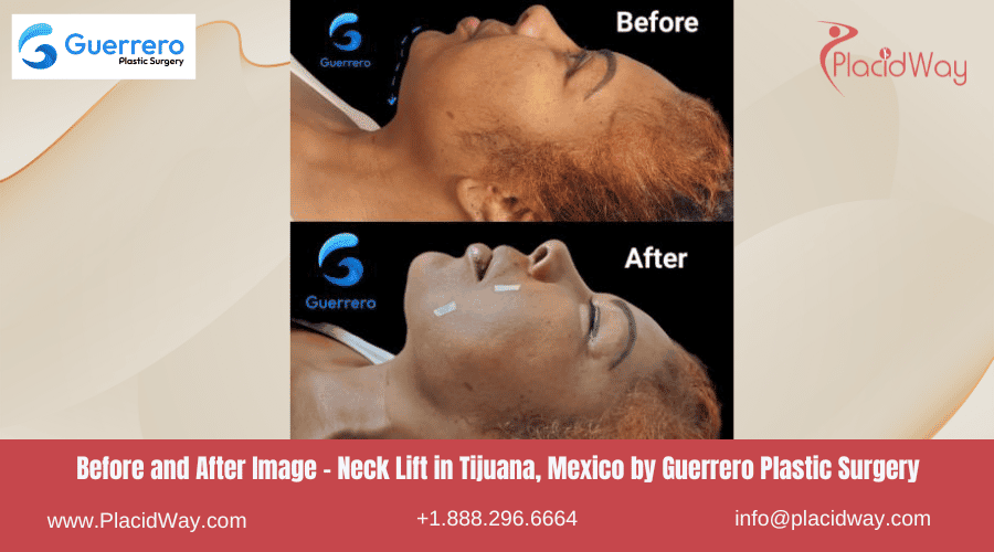 Lifting de Cuello en Tijuana México - Guerrero
