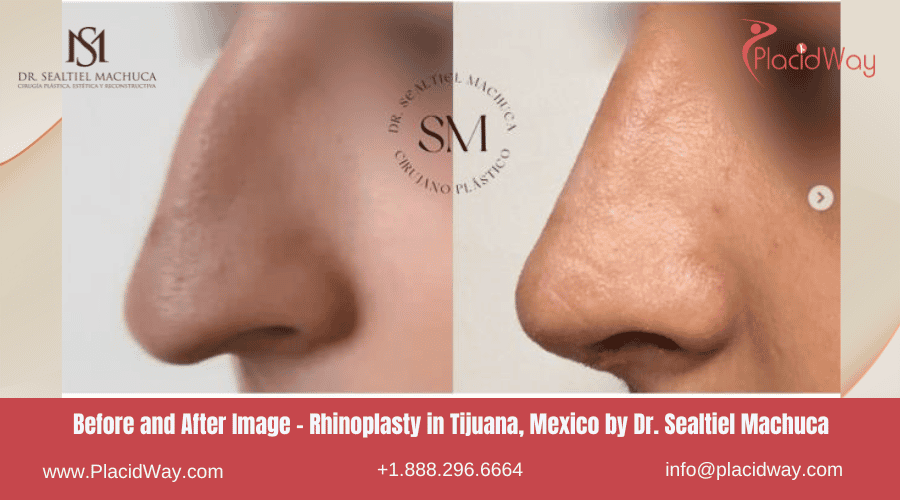Rhinoplasty In Tijuana Mexico   Dr Sealtiel