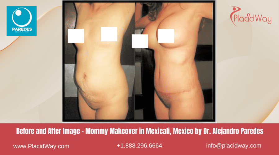 MMO en Mexicali México - Dr Paredes