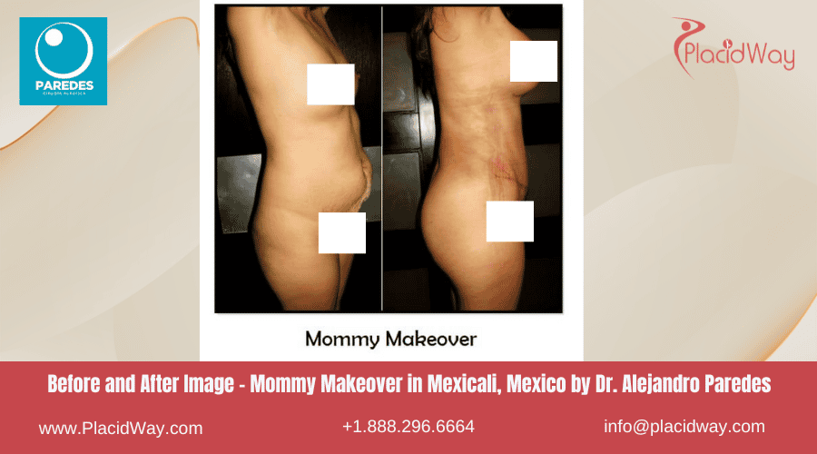 Mommy Makeover en Mexicali México - Dr Paredes
