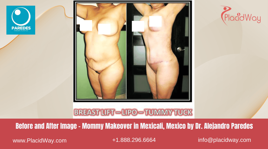 Mommy Makeover en Mexicali México por el Dr. Alejandro Paredes