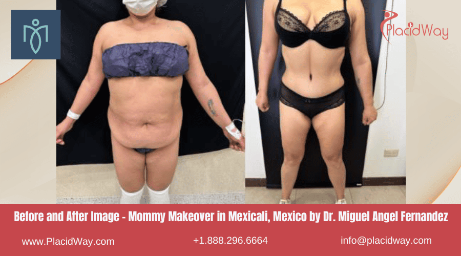 Mommy Makeover en Mexicali México por el Dr. Miguel Ángel Fernández