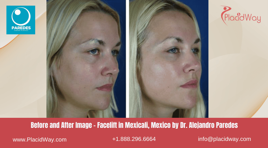 Lifting facial en Mexicali México por el Dr. Paredes