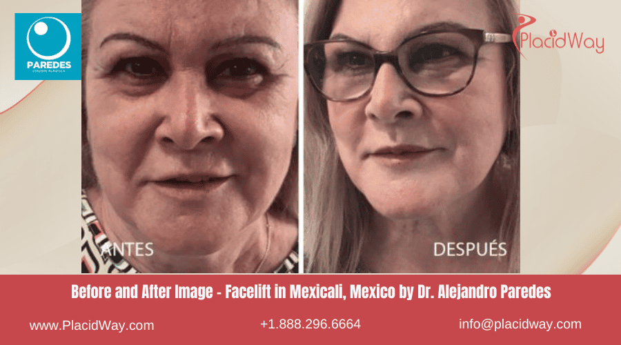 Lifting facial en Mexicali México por el Dr. Alejandro Paredes