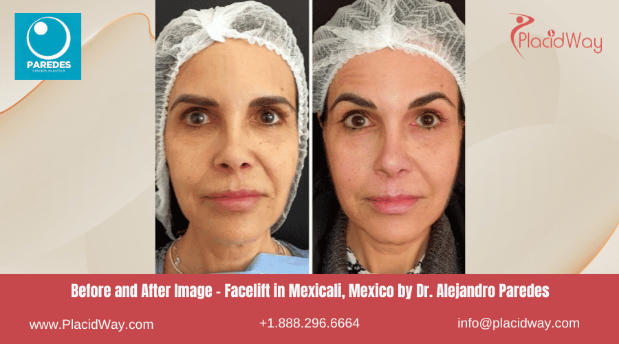 Lifting facial en Mexicali México en la Clínica del Dr. Alejandro Paredes