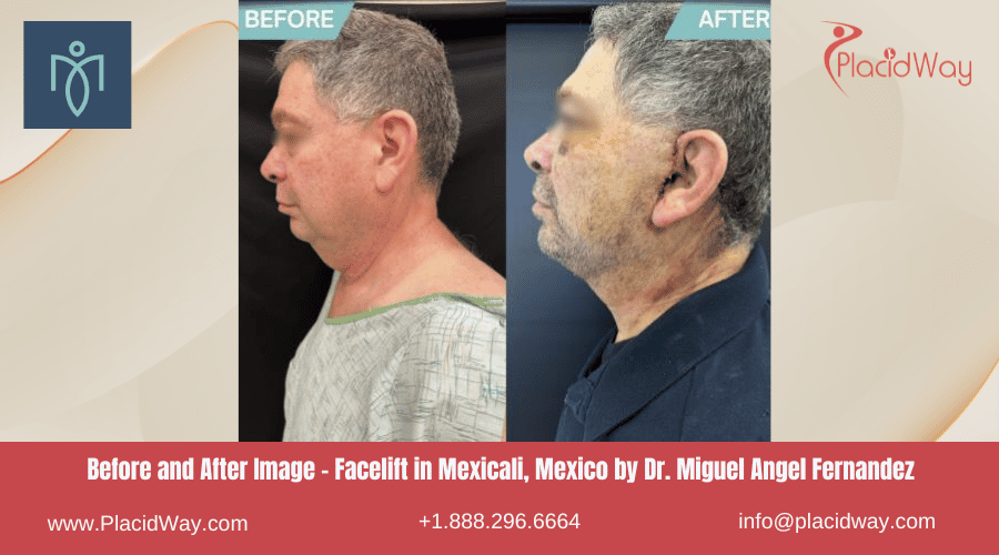 Lifting facial en Mexicali México por la Clínica del Dr. Miguel Ángel Fernández