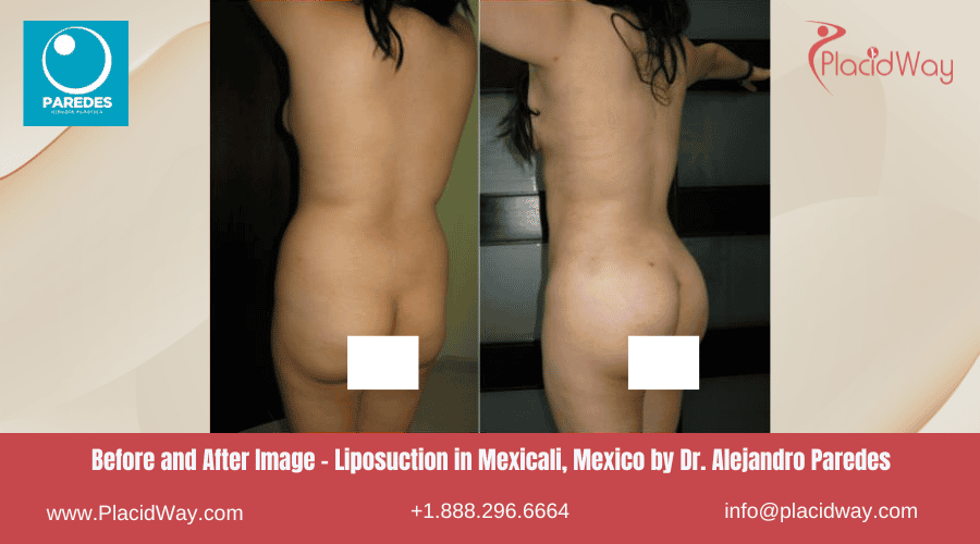 Liposucción en Mexicali México por el Dr. Paredes