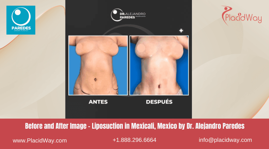Liposucción en Mexicali México por la Clínica del Dr. Paredes