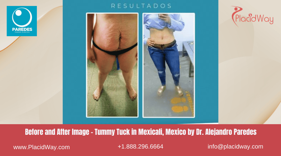 Abdominoplastia en Mexicali México en el Dr. Paredes