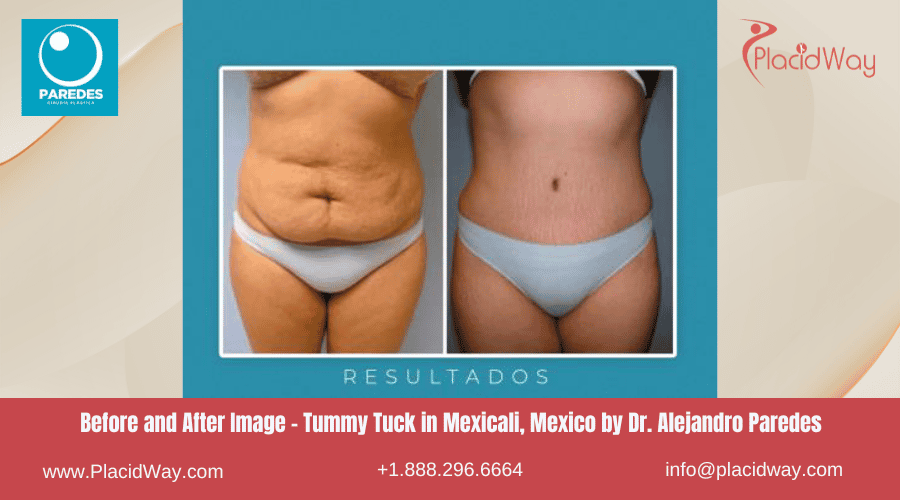 Abdominoplastia en Mexicali México con el Dr. Alejandro Paredes