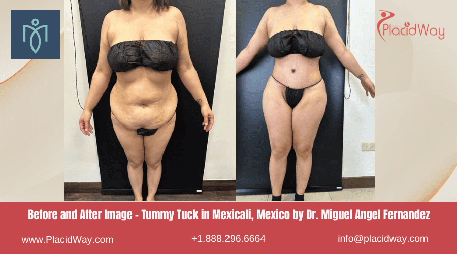 Abdominoplastia en Mexicali México por la Clínica del Dr. Miguel Angel Fernández