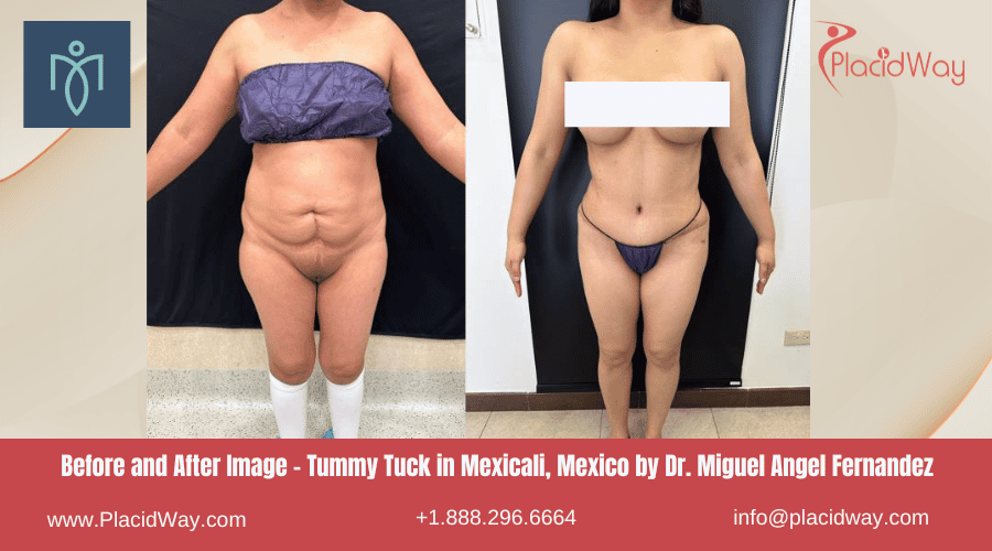 Abdominoplastia en Mexicali México por el Dr. Miguel Angel Fernández Centro
