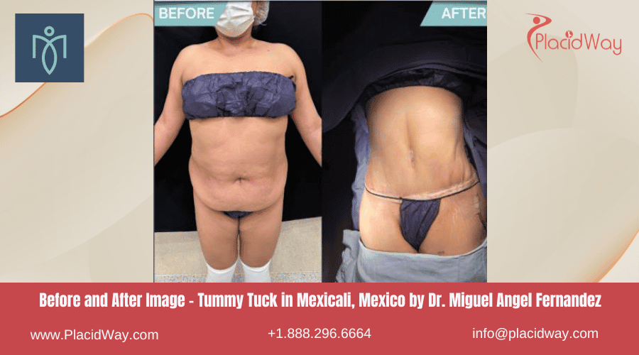 Abdominoplastia en Mexicali México con el Dr. Miguel Angel Fernández