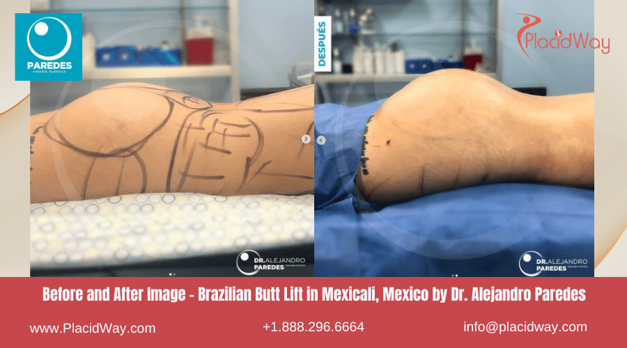 BBL en Mexicali México por el Dr. Paredes