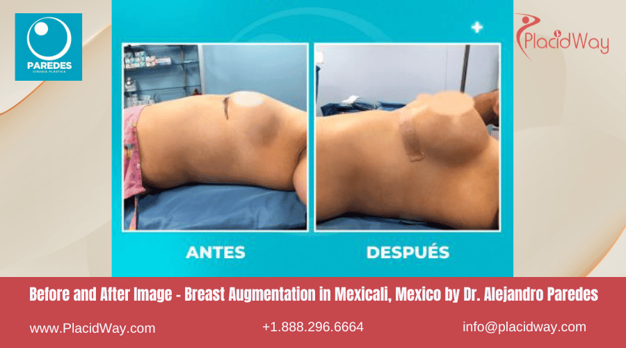 Aumento de Senos en Mexicali México en el Centro Dr Paredes
