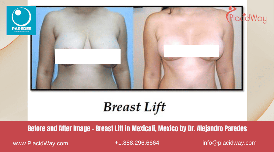 Breast Lift in Mexicali Mexico by Dr Paredes
