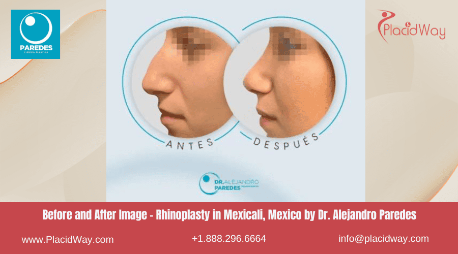 Rinoplastia en Mexicali México por la Clínica del Dr. Paredes