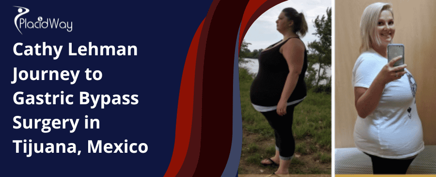 El viaje de Cathy Lehman hacia la cirugía de bypass gástrico en Tijuana, México