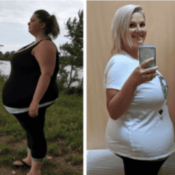 Cirugía bariátrica de la obesidad