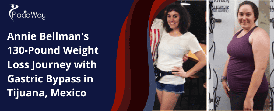 El viaje de Annie Bellman para perder 130 libras de peso con bypass gástrico en Tijuana, México