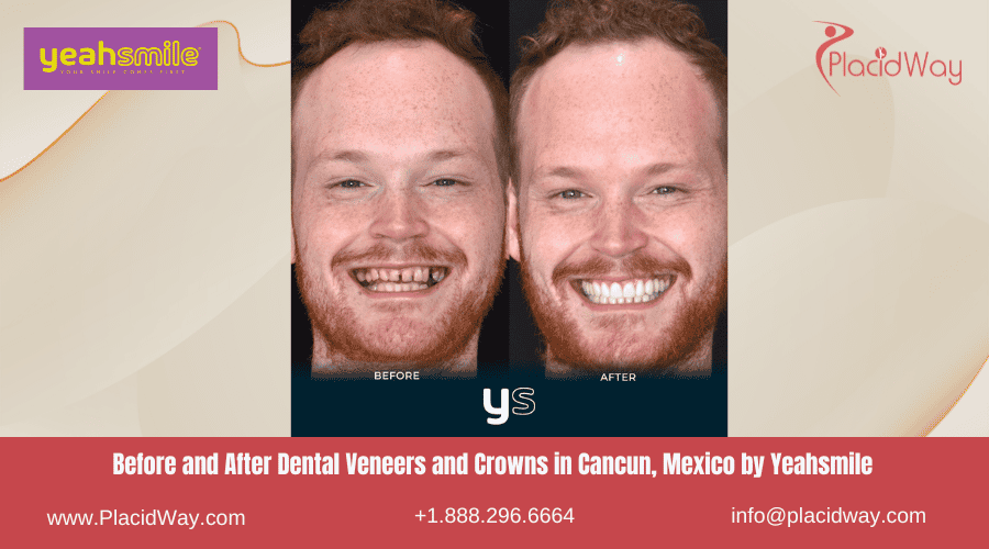 Antes y después de carillas y coronas dentales en Cancún, México
