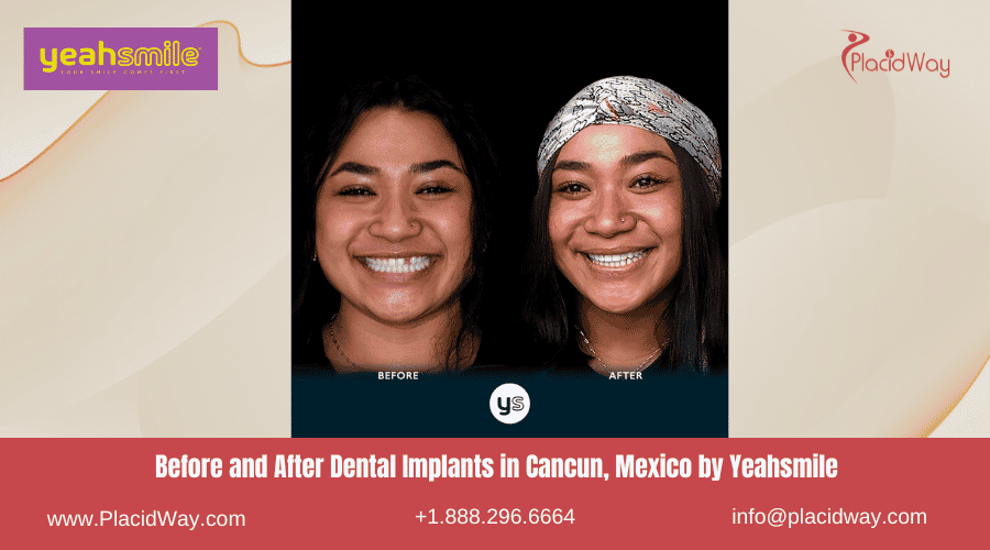 Antes y después de implantes dentales en Cancún, México por Yeahsmile
