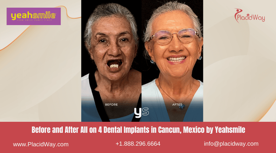 Antes y después de All on 4 implantes dentales en Cancún, México por Yeahsmile