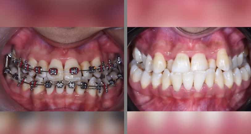 Zahnspangen in Kairo, Ägypten