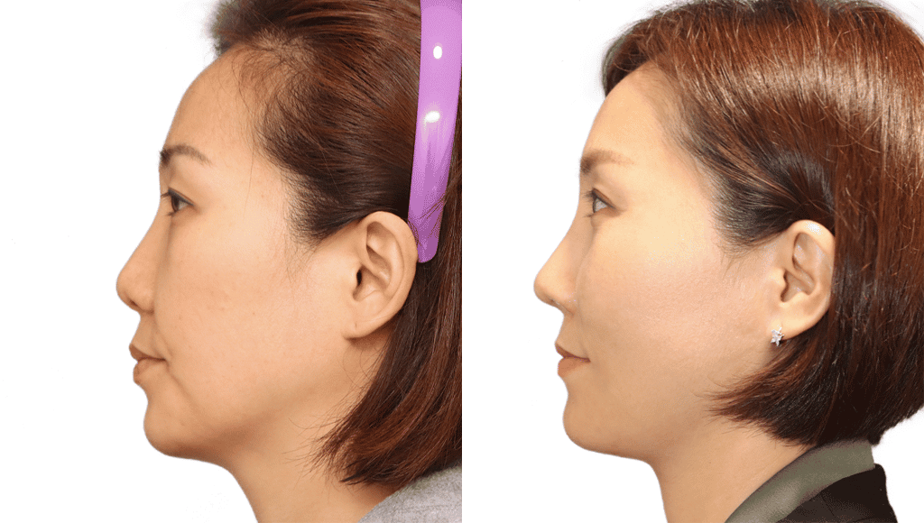 عملية تجميل الأنف قبل وبعد في مركز JW لجراحة التجميل في سيول، كوريا الجنوبية
