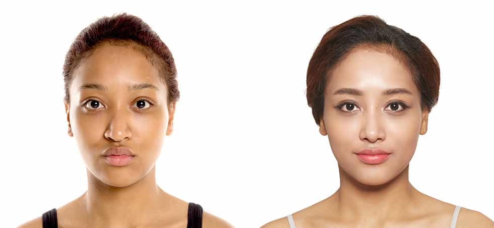 Patient Testimonial of Rhinoplasty: Before-After