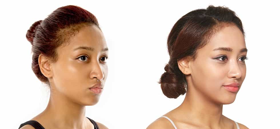 Patient Testimonial of Rhinoplasty: Before-After