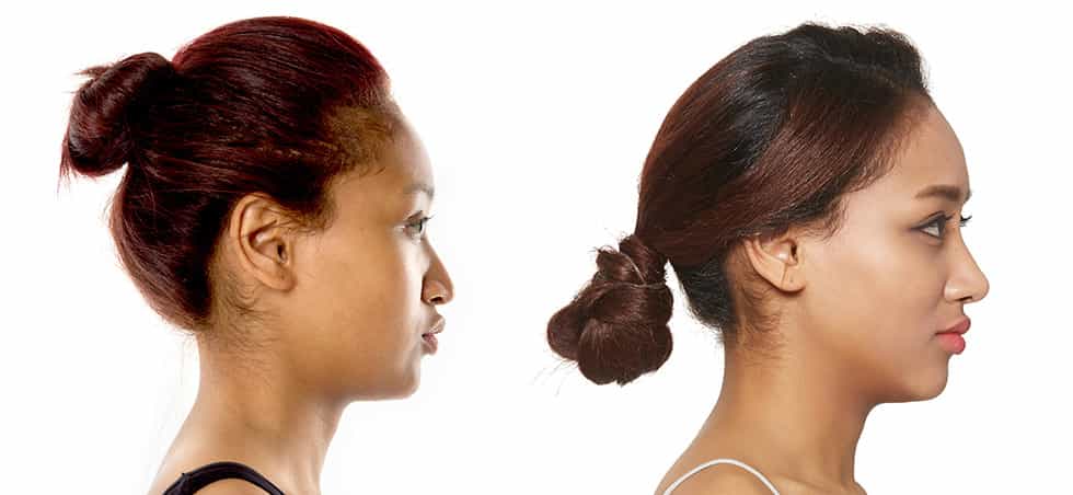 Patient Testimonial of Rhinoplasty: Before-After