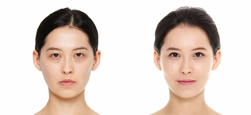 Before and After of Eyelid Surgery in Seoul, South Korea