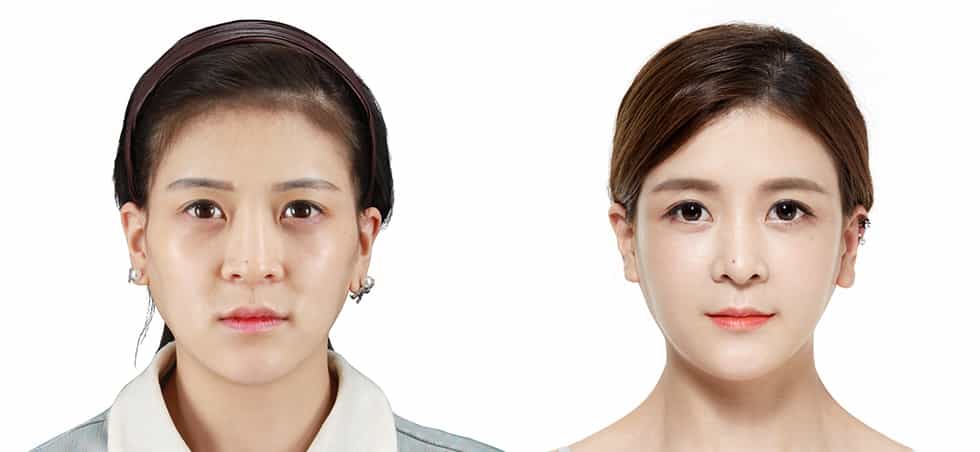 Before and After of Facial Surgery in Seoul, South Korea