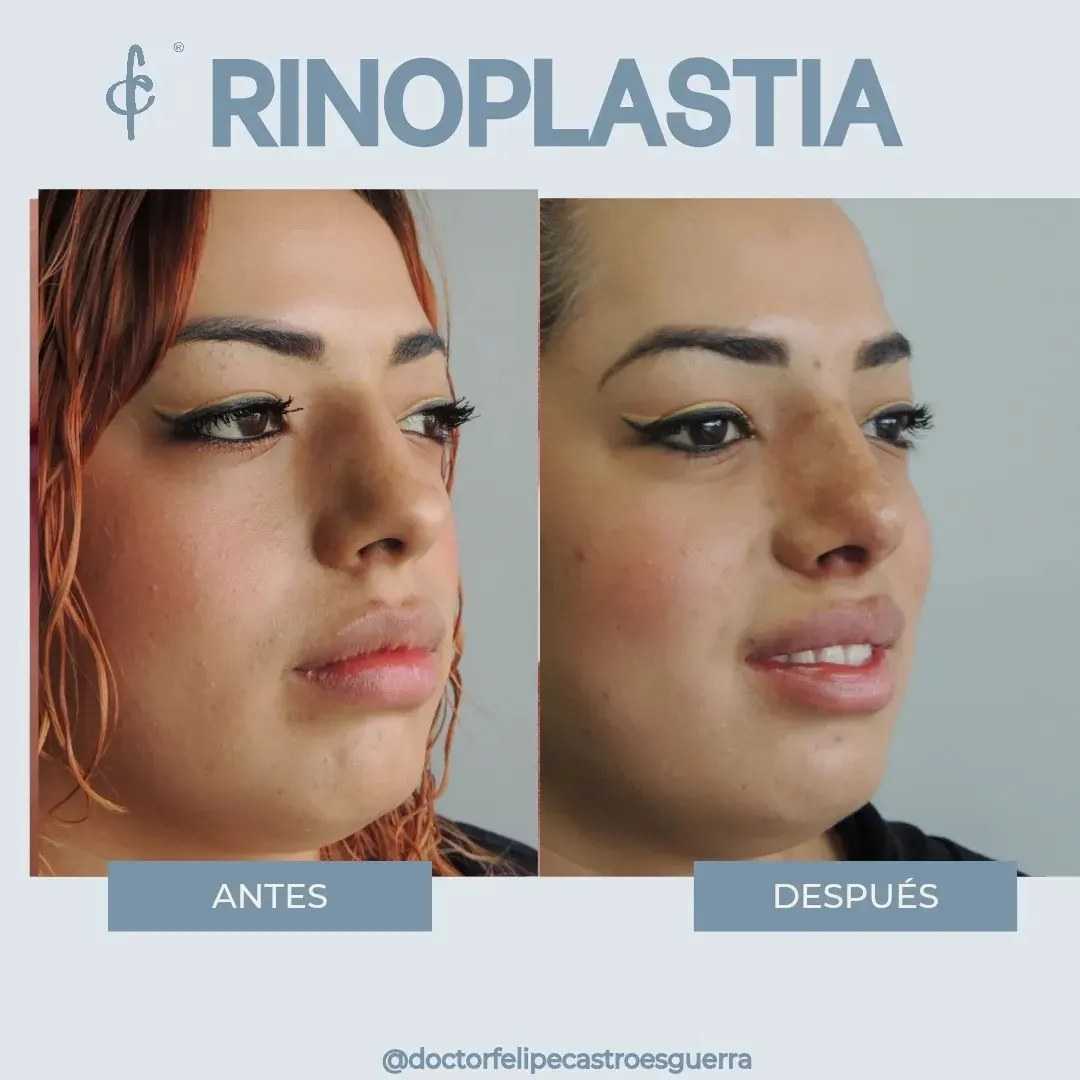 Paquete Rinoplastia en Bogota Colombia