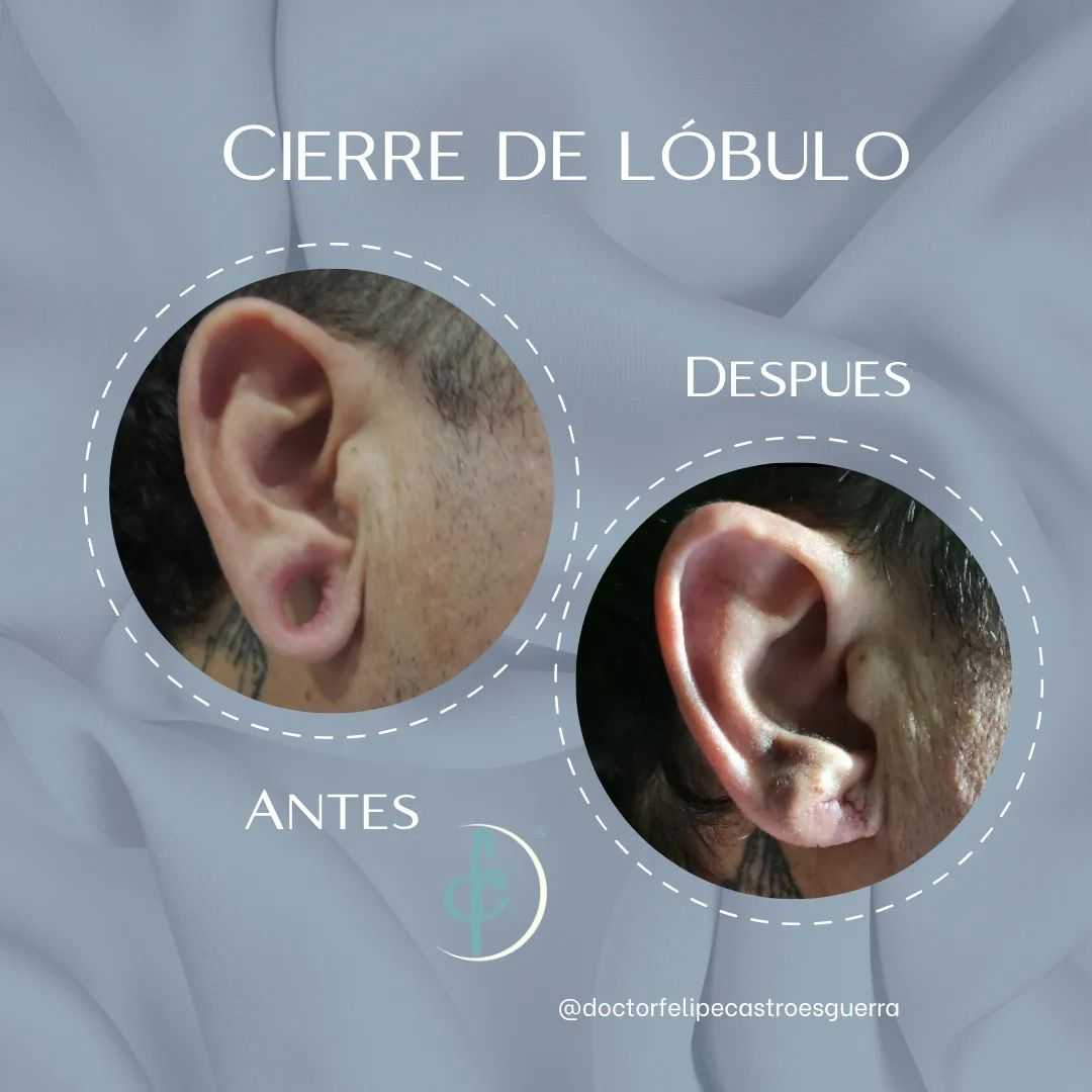 Paquete de Otoplastia en Bogotá Colombia