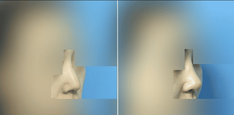 Фотографии до и после результатов косметической операции в Сеуле, Южная Корея