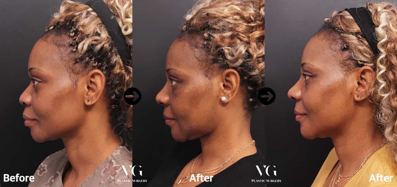 Фото до и после ринопластики в Сеуле, Южная Корея