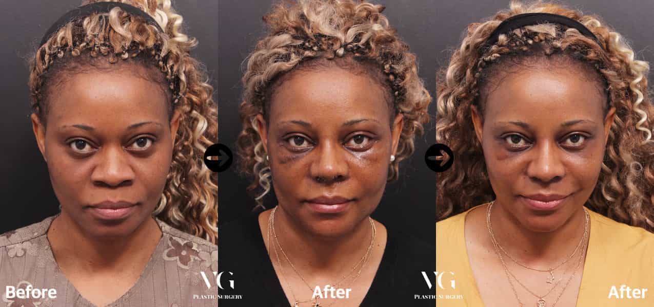 Фото до и после ринопластики в Сеуле, Южная Корея