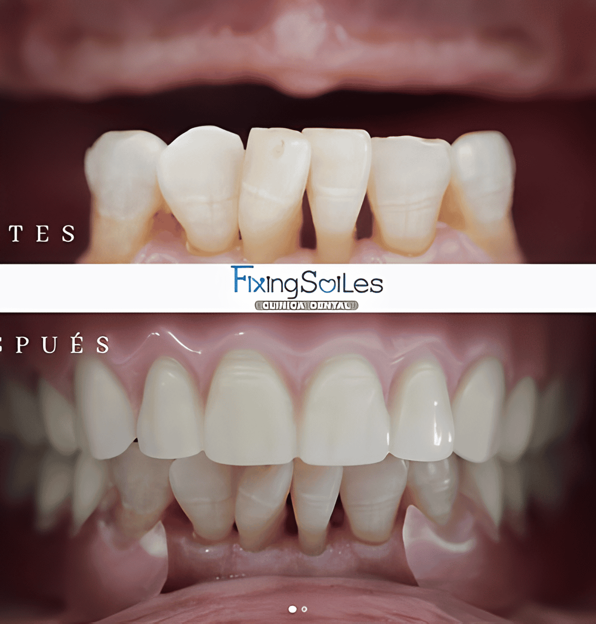 Antes y después de los implantes dentales All-on-4 en Los Algodones, México