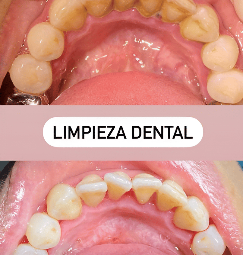 Limpieza dental antes y después en Los Algodones, México