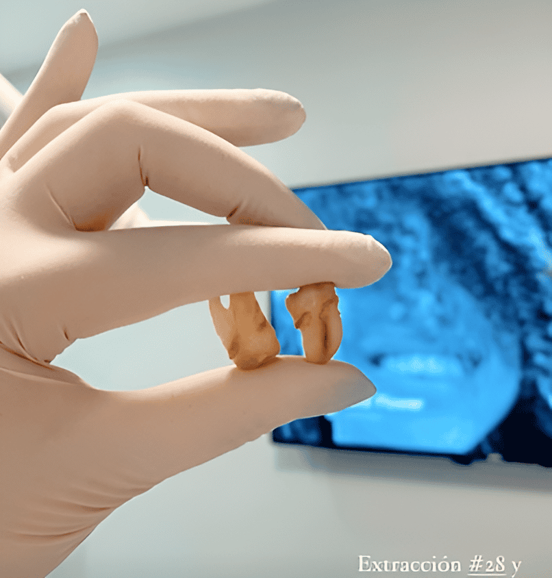 Antes y después de una extracción dental en Los Algodones, México