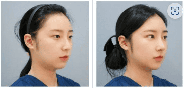 До и после пластической хирургии в Сеуле, Южная Корея