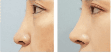 До и после пластической операции в Южной Корее