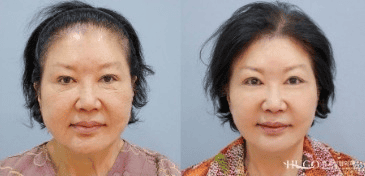 До и после косметической операции в Сеуле, Южная Корея
