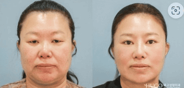 Пластическая хирургия в Сеуле Южная Корея До После