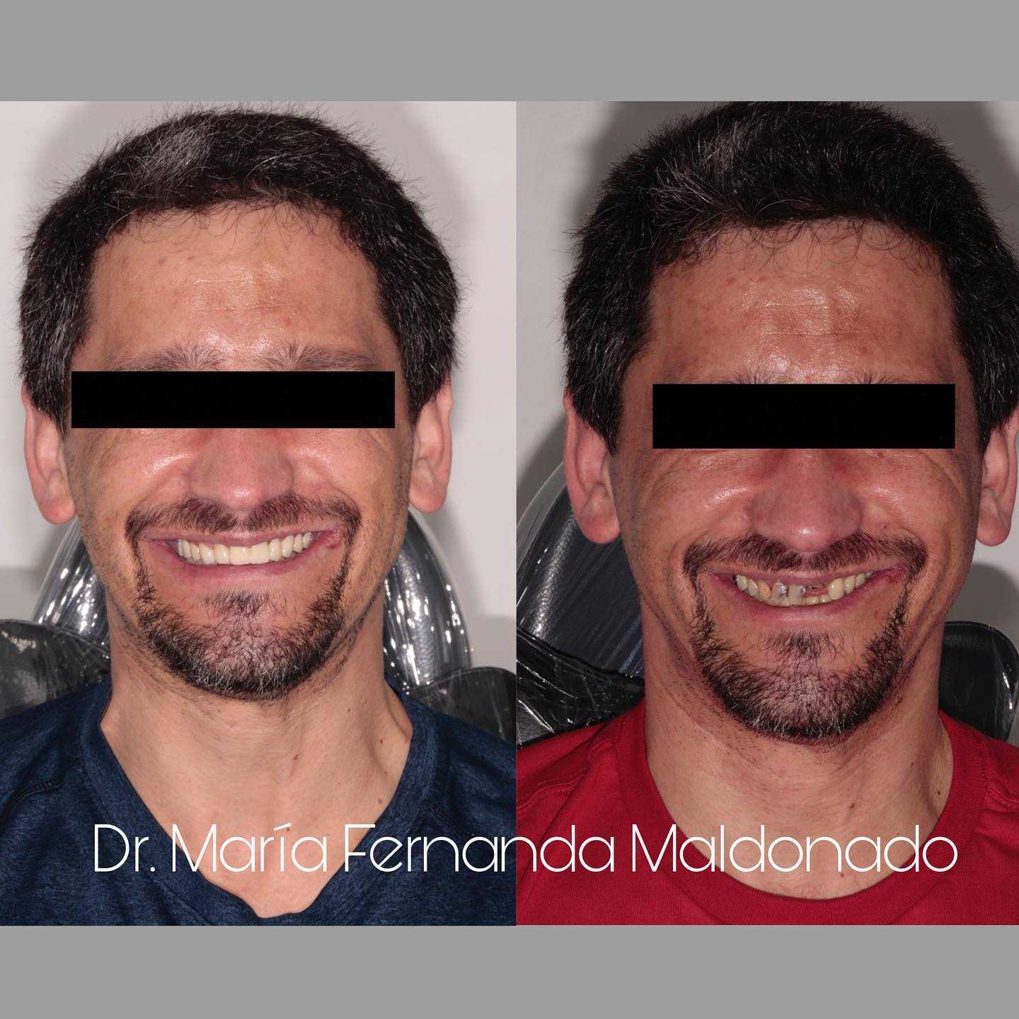 Imagen de antes y después de All on 4 Implantes Dentales en Los Algodones México