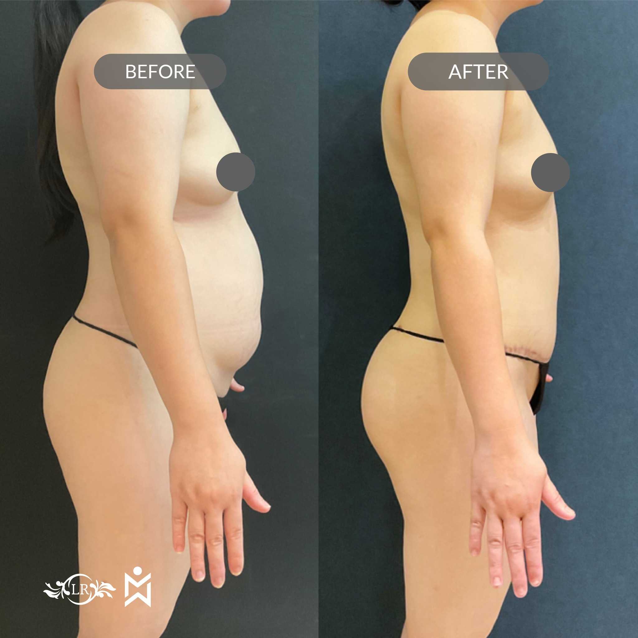 Antes y Después de Levantamiento de Senos y Liposucción en Santo Domingo República Dominicana