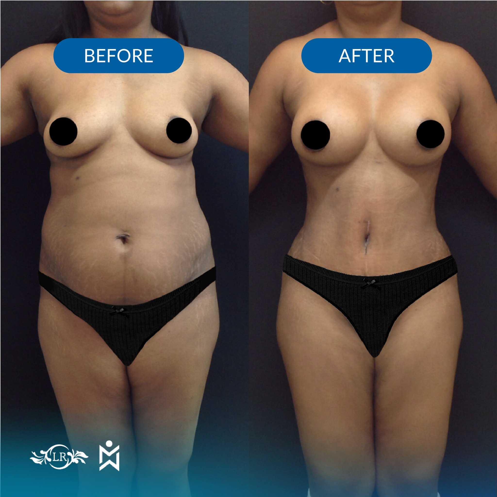 Antes y después de Mommy Makeover en Santo Domingo República Dominicana