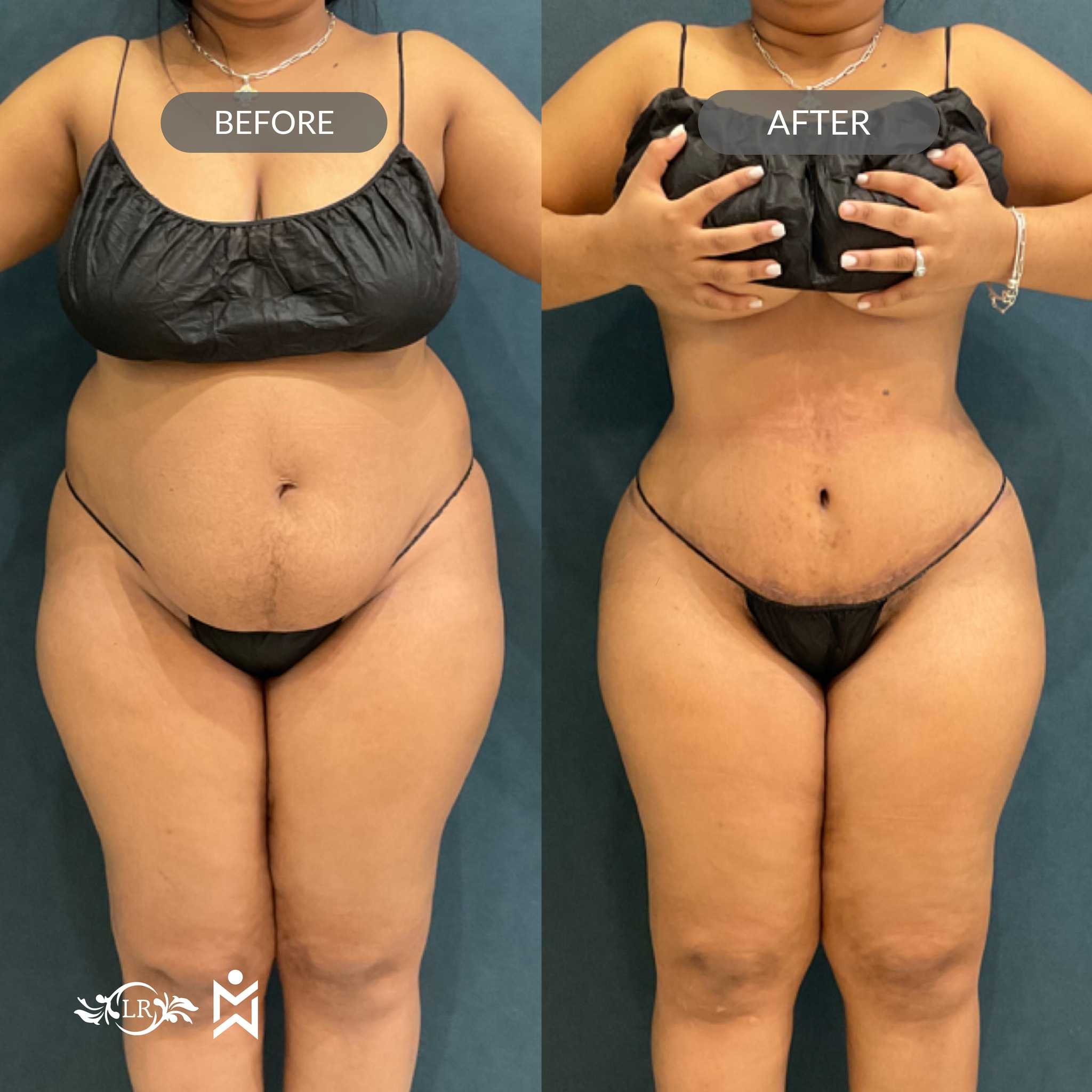 Antes y Después de Abdominoplastia y Liposucción en Santo Domingo República Dominicana